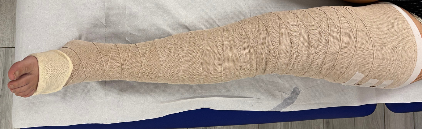 Trattamento del linfedema secondo EBM e linee guida